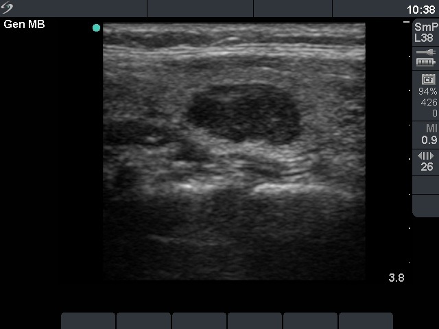Right lobe, longitudinal scan