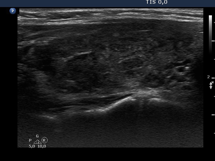 Right lobe, longitudinal scan