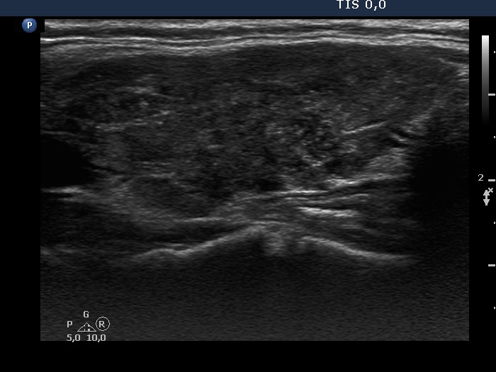 Right lobe, longitudinal scan