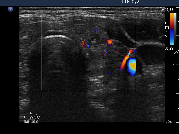 Right lobe, longitudinal scan