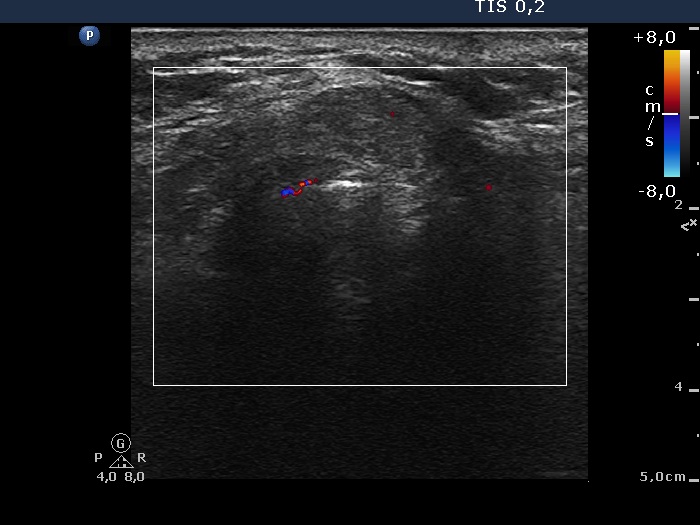 Right lobe, longitudinal scan