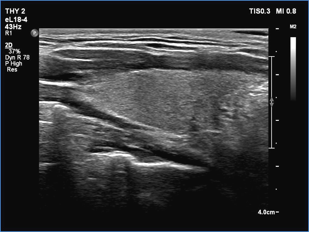 Right lobe, longitudinal scan