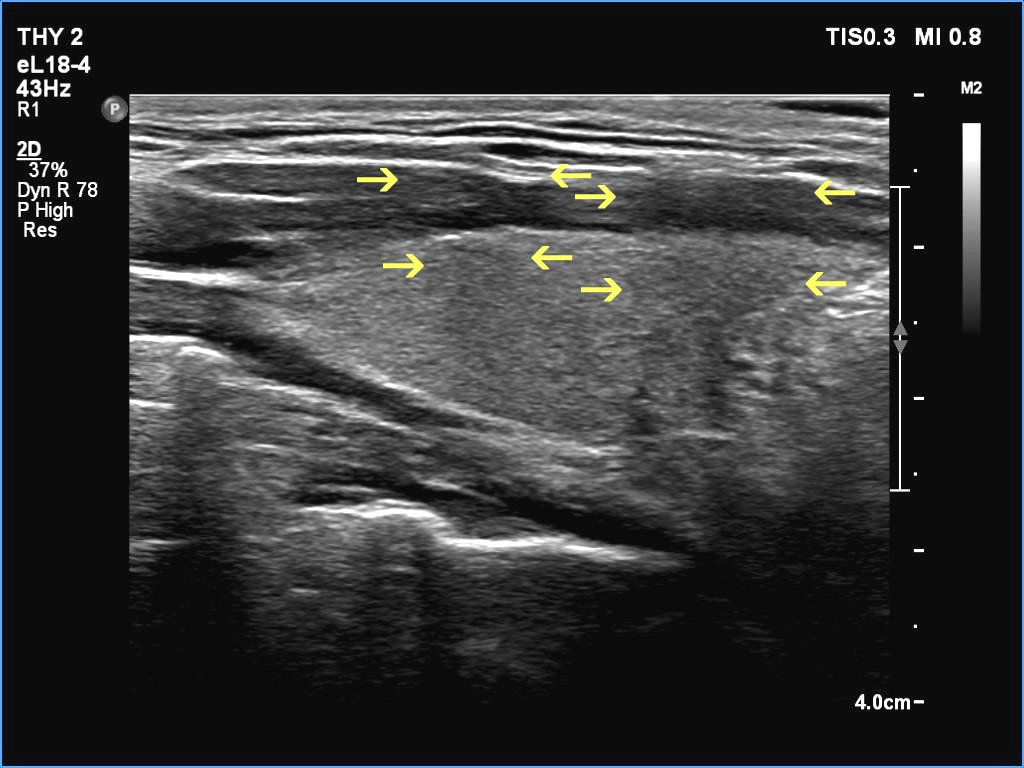 Right lobe, longitudinal scan