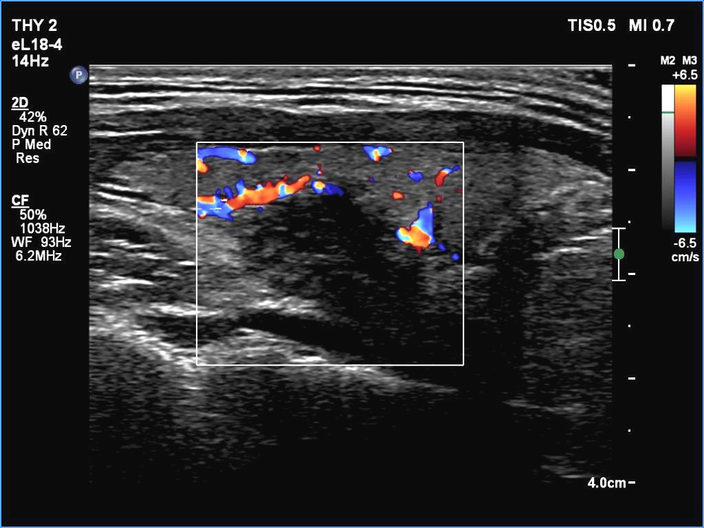 Right lobe, longitudinal scan