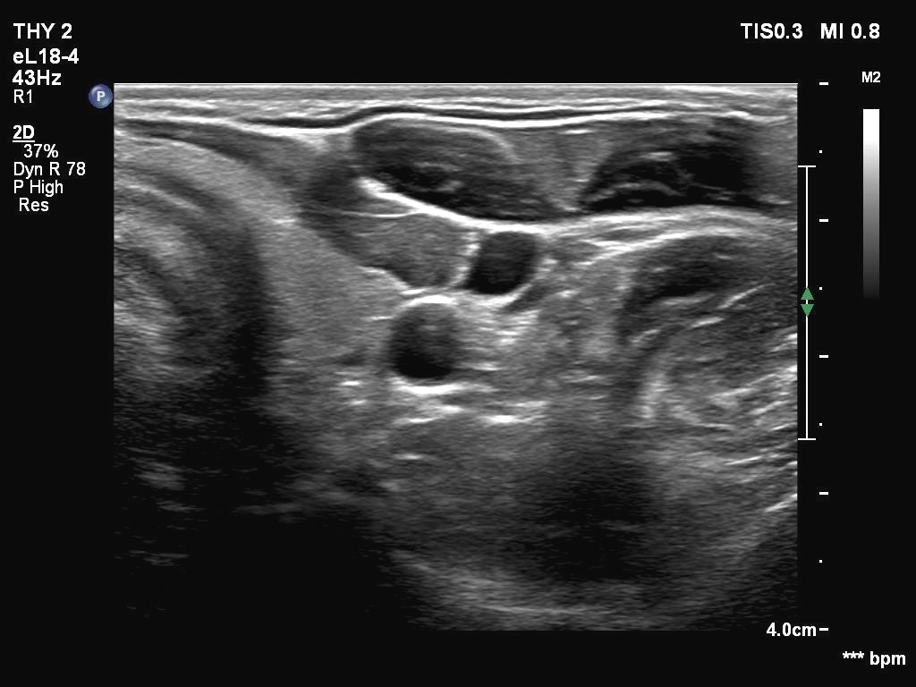 Right lobe, longitudinal scan