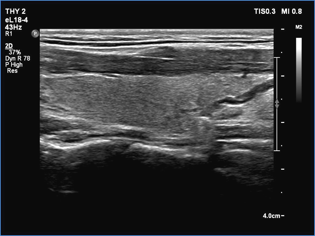 Right lobe, longitudinal scan