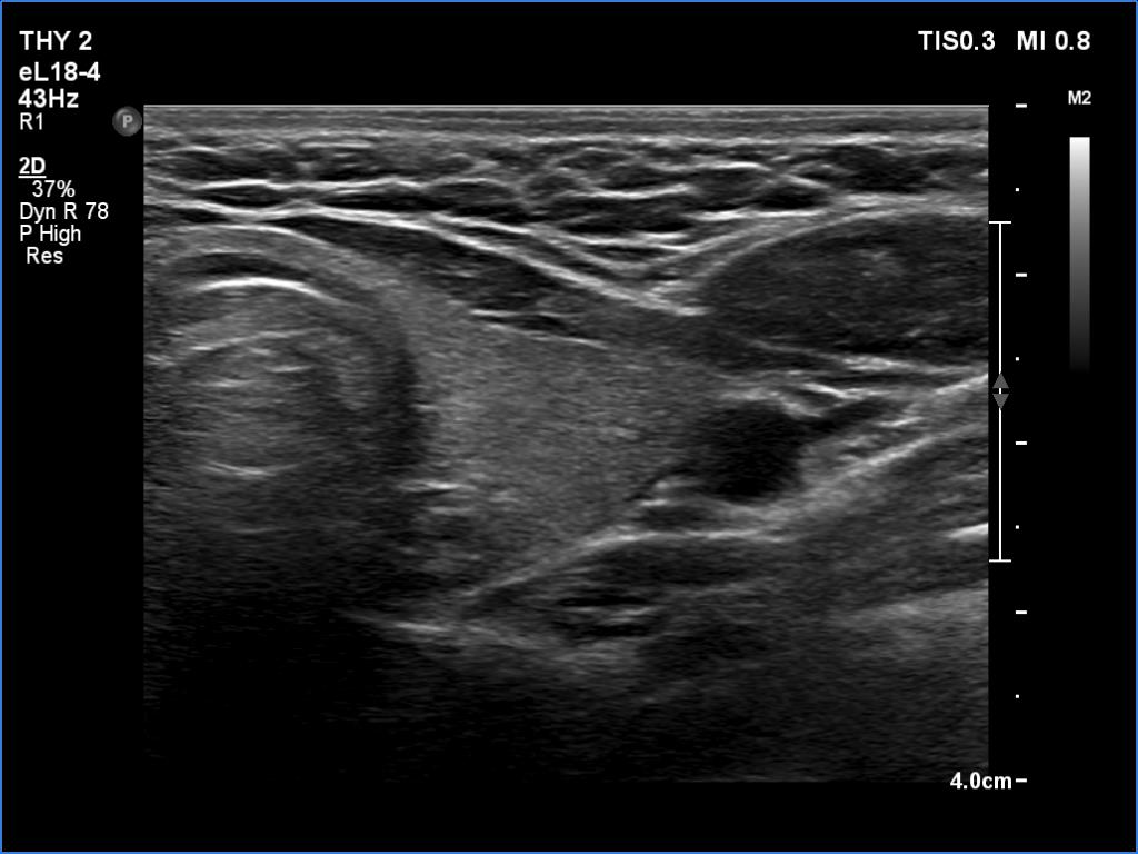 Right lobe, longitudinal scan