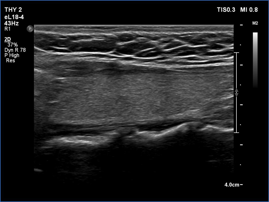 Right lobe, longitudinal scan
