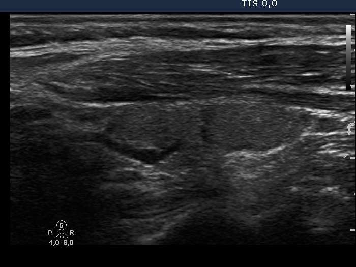 Right lobe, longitudinal scan