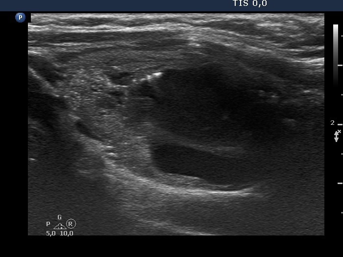 Right lobe, longitudinal scan