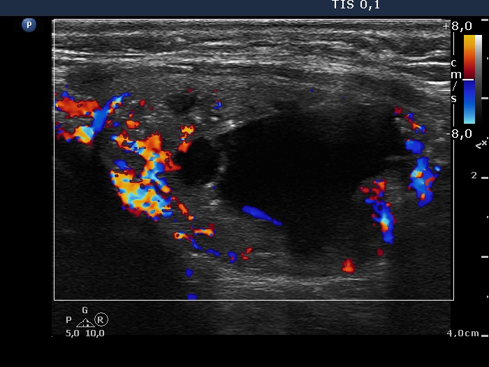 Right lobe, longitudinal scan
