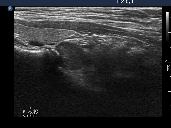 Right lobe, longitudinal scan