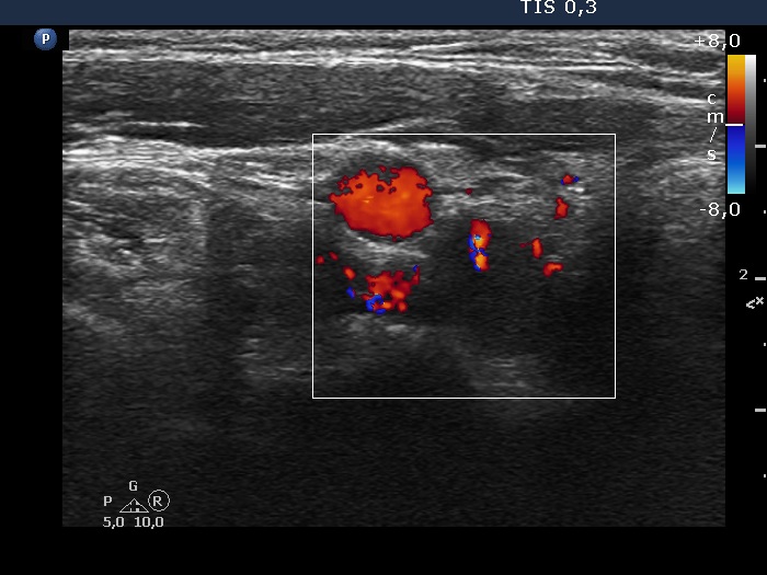 Right lobe, longitudinal scan