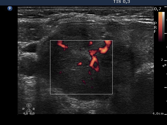 Right lobe, longitudinal scan