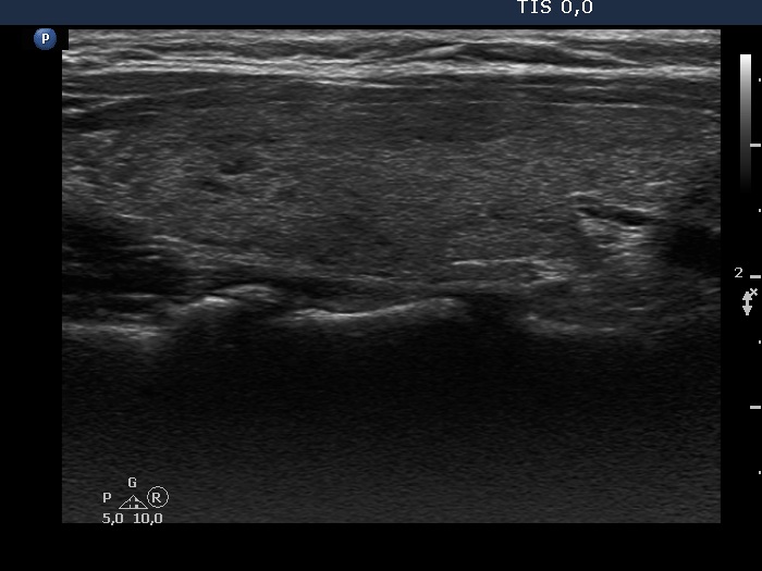 Right lobe, longitudinal scan