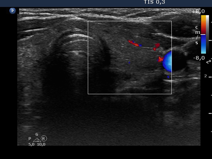 Right lobe, longitudinal scan