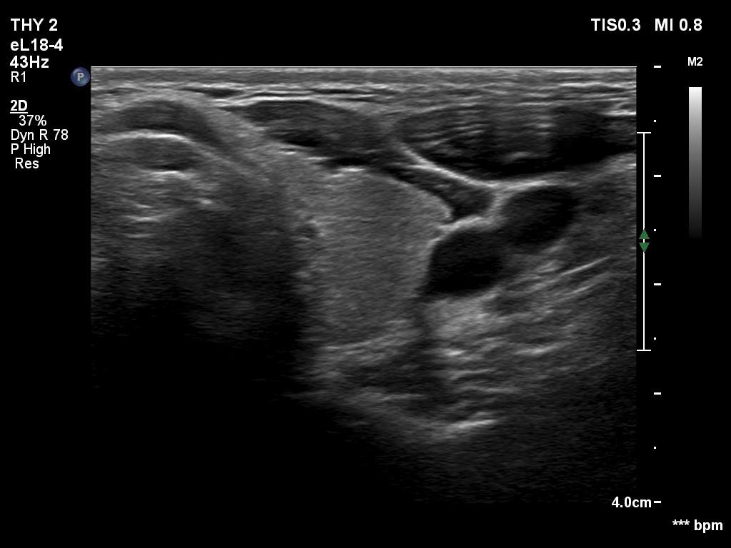 Right lobe, longitudinal scan
