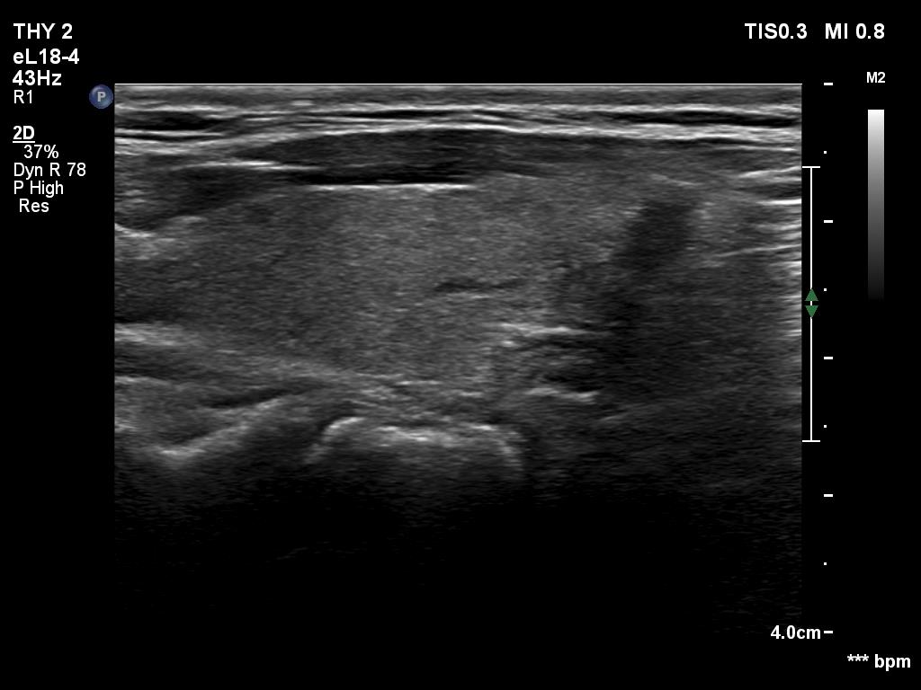 Right lobe, longitudinal scan