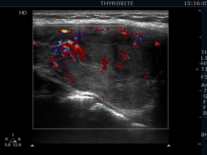 Right lobe, longitudinal scan