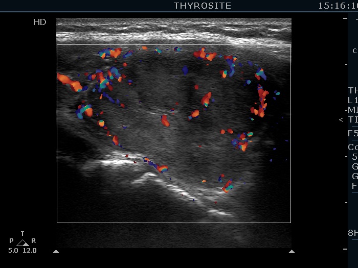 Right lobe, longitudinal scan