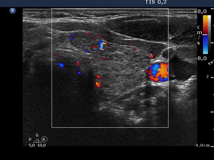 Right lobe, longitudinal scan