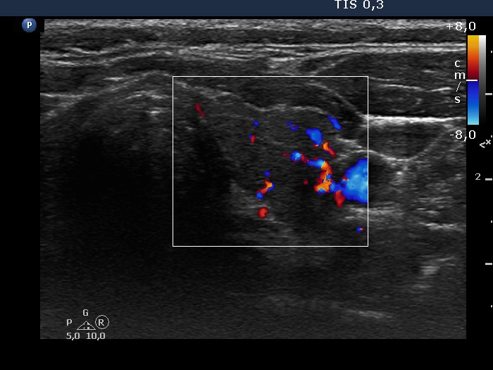 Right lobe, longitudinal scan