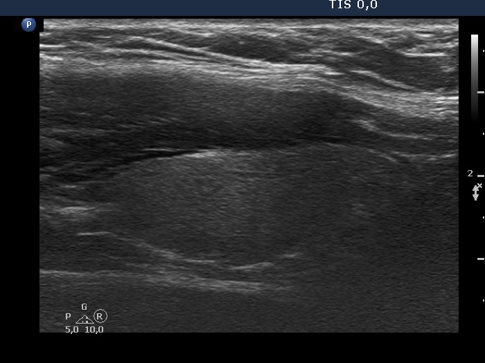 Right lobe, longitudinal scan