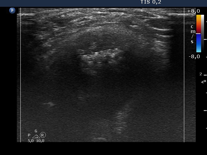 Right lobe, longitudinal scan