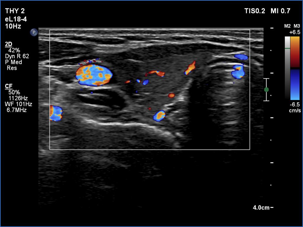 Right lobe, longitudinal scan