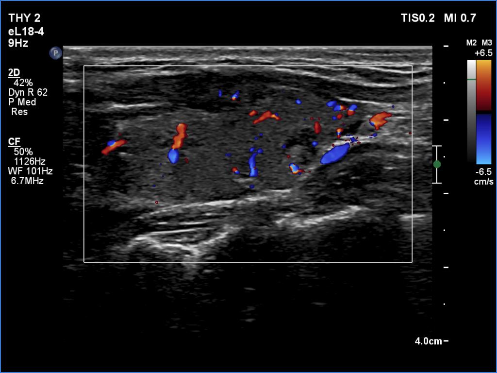 Right lobe, longitudinal scan