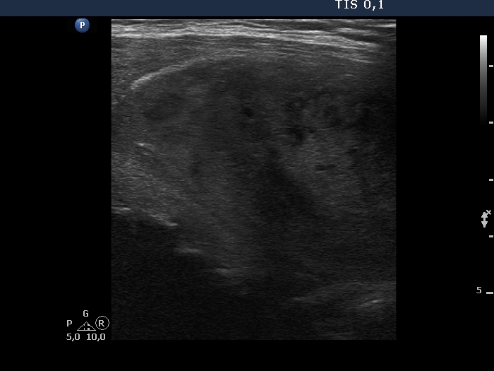 Right lobe, longitudinal scan