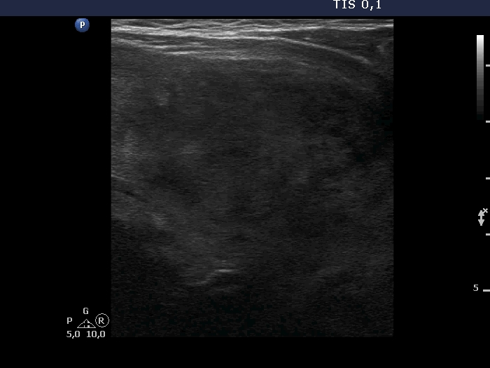 Right lobe, longitudinal scan