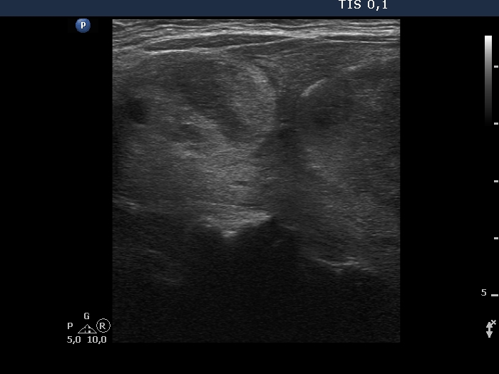 Right lobe, longitudinal scan