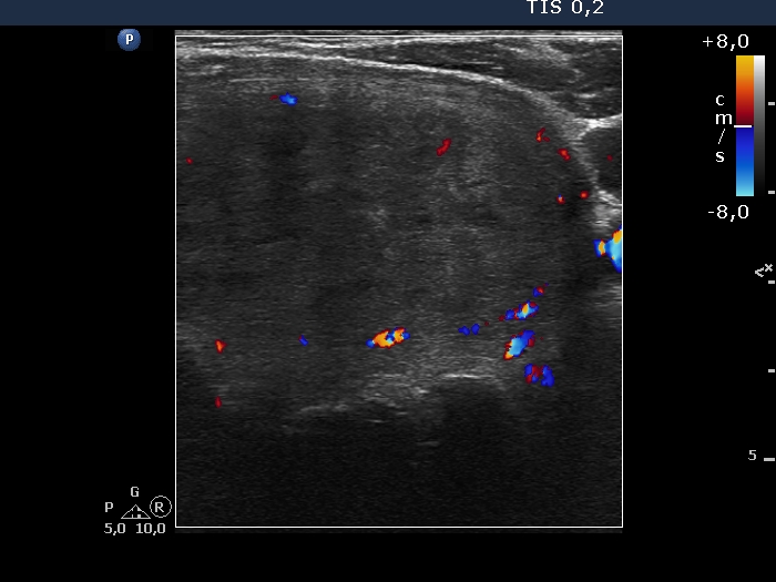 Right lobe, longitudinal scan