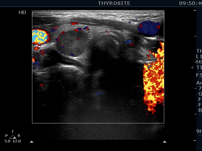 Right lobe, longitudinal scan