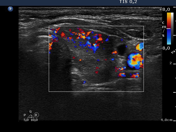Right lobe, longitudinal scan