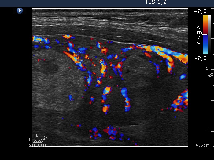 Right lobe, longitudinal scan