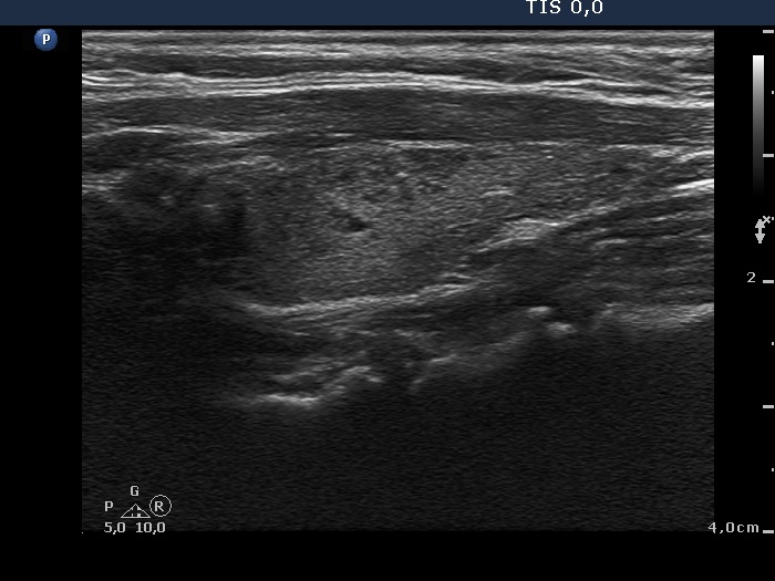 Right lobe, longitudinal scan