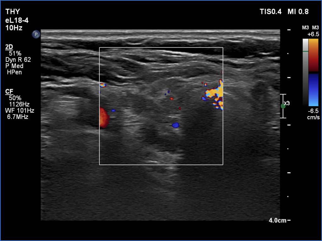 Right lobe, longitudinal scan