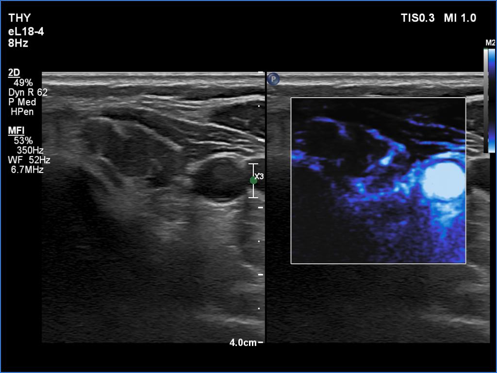 Right lobe, longitudinal scan