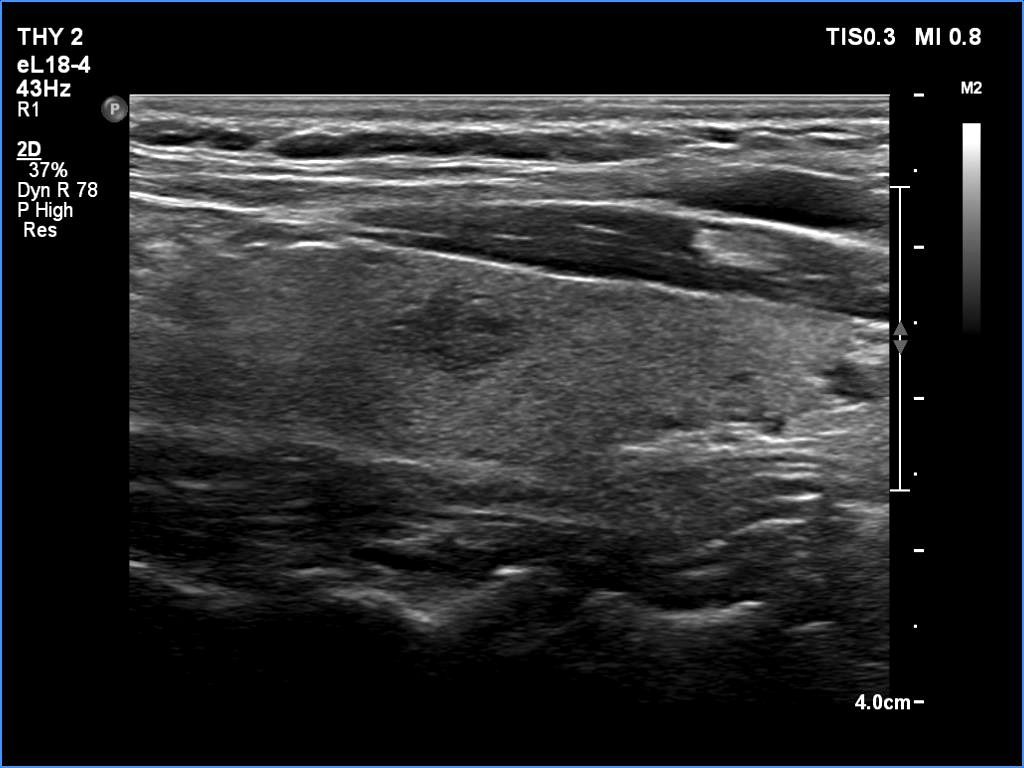 Right lobe, longitudinal scan