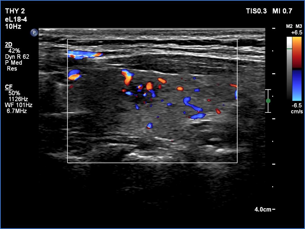 Right lobe, longitudinal scan