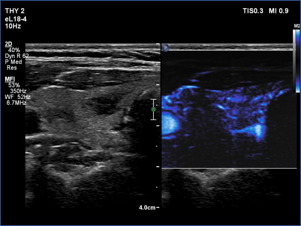 Right lobe, longitudinal scan