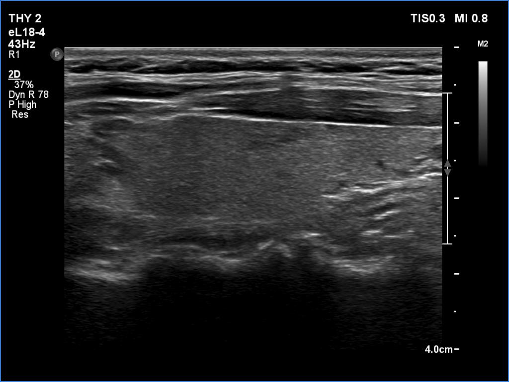 Right lobe, longitudinal scan