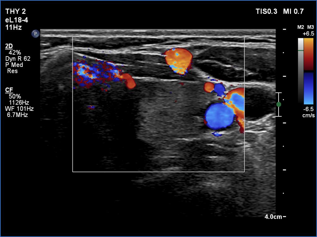 Right lobe, longitudinal scan