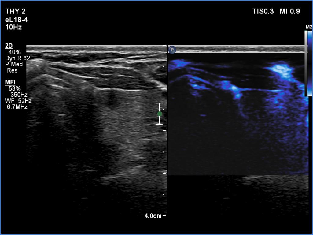 Right lobe, longitudinal scan