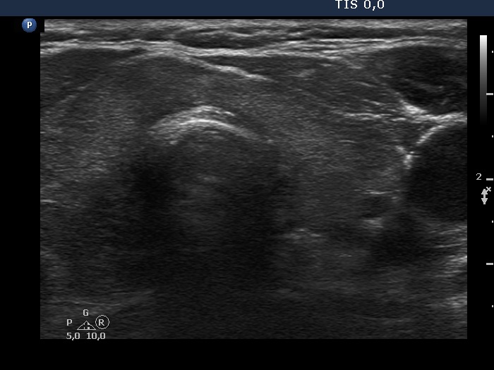 Right lobe, longitudinal scan