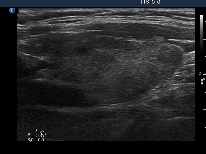 Right lobe, longitudinal scan