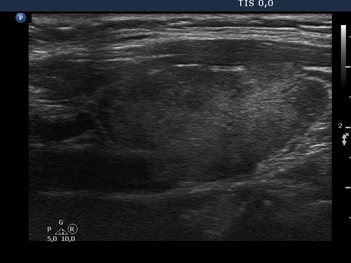 Right lobe, longitudinal scan