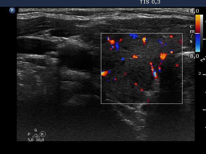Right lobe, longitudinal scan